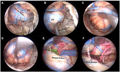 Endoscopic transorbital resection of the temporal lobe: anatomic qualitative and quantitative study